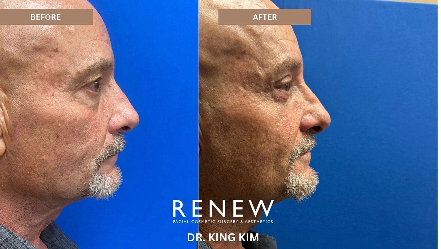 Blepharoplasty Before & After