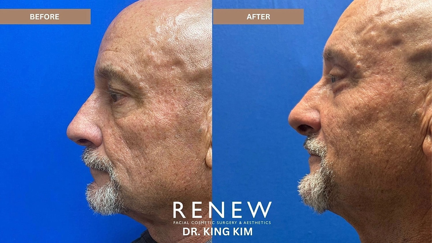 Blepharoplasty Before & After
