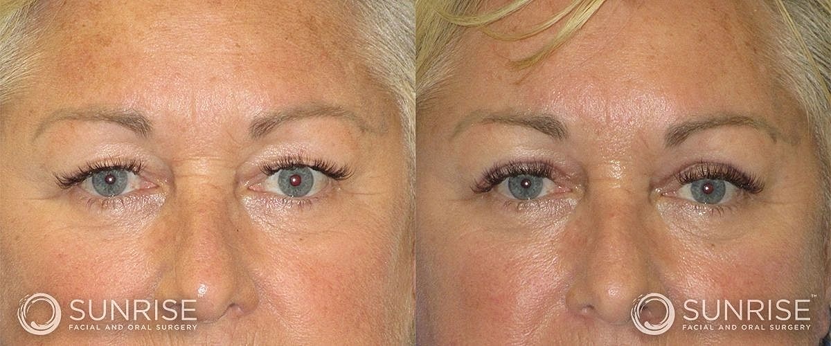 Blepharoplasty Before & After
