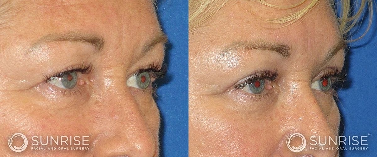 Blepharoplasty Before & After