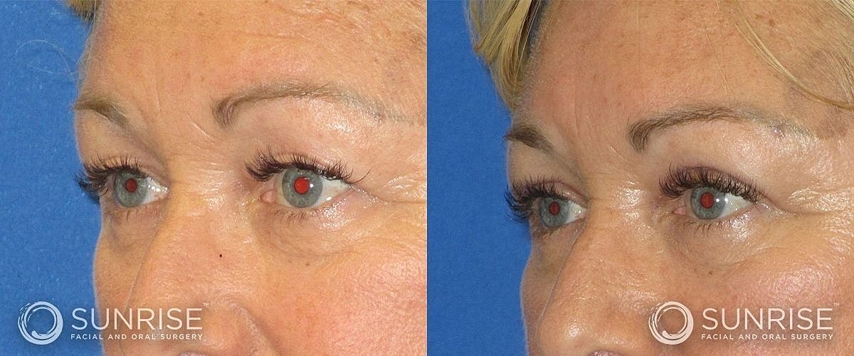 Blepharoplasty Before & After