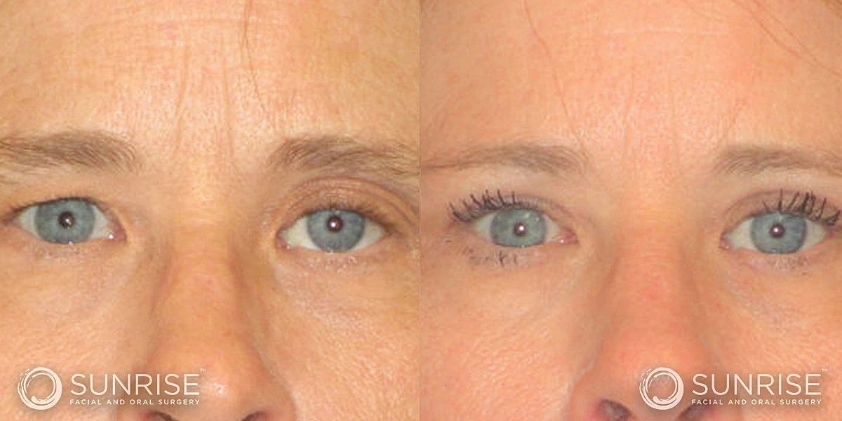 Blepharoplasty Before & After