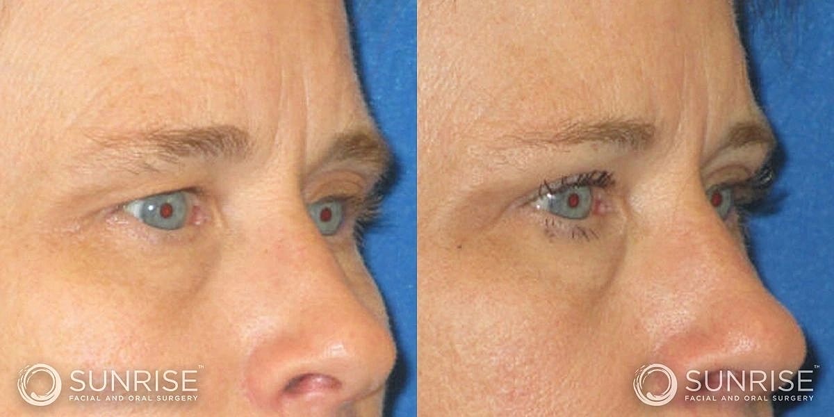 Blepharoplasty Before & After