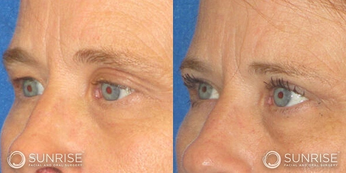 Blepharoplasty Before & After