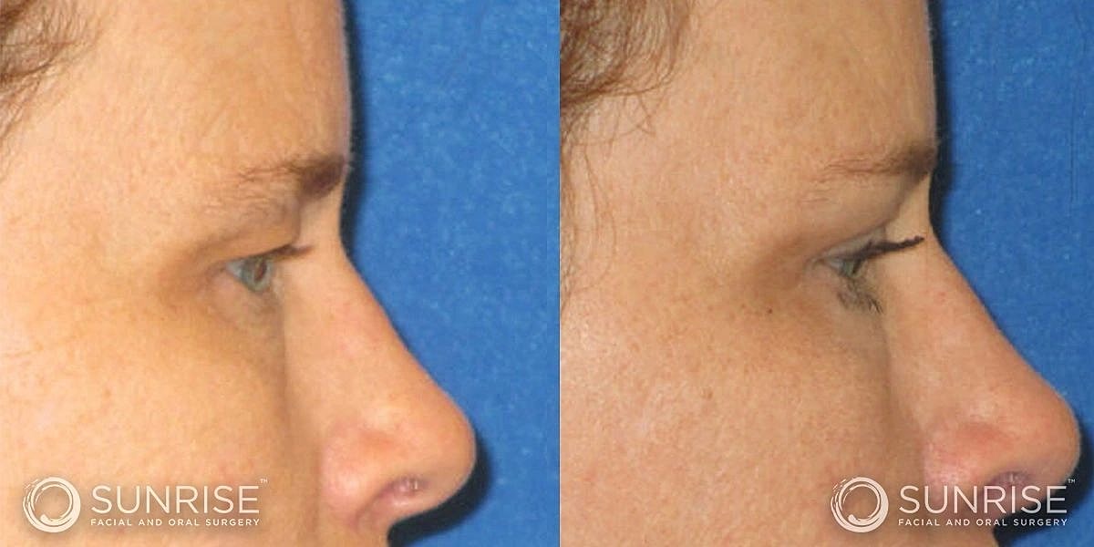 Blepharoplasty Before & After