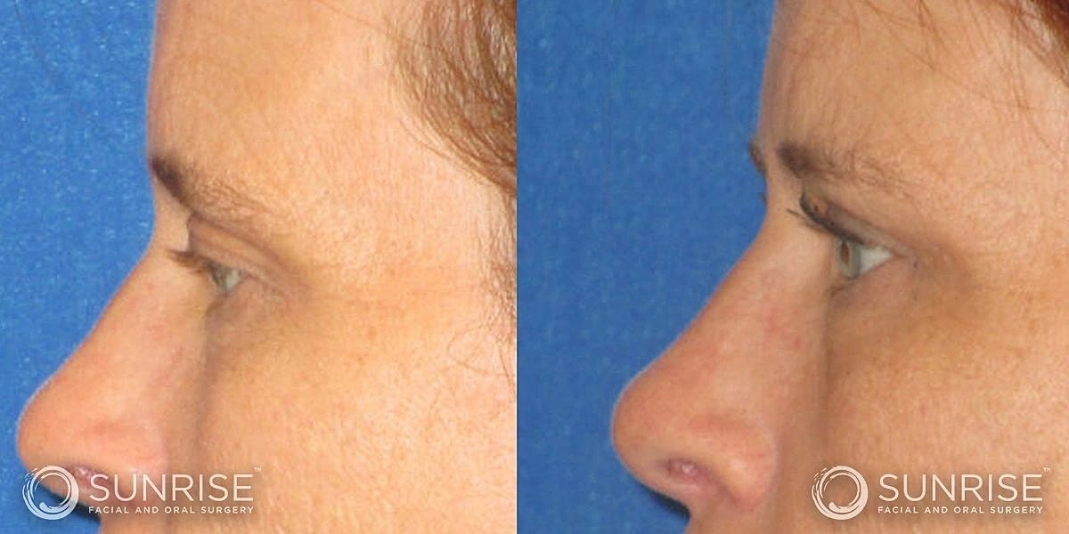 Blepharoplasty Before & After
