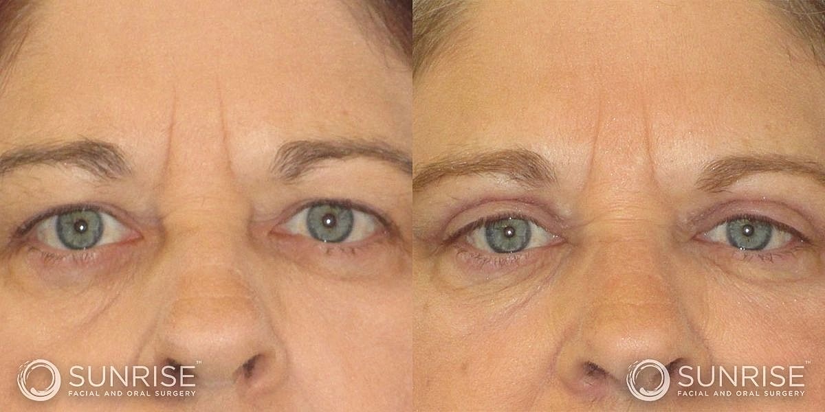 Blepharoplasty Before & After