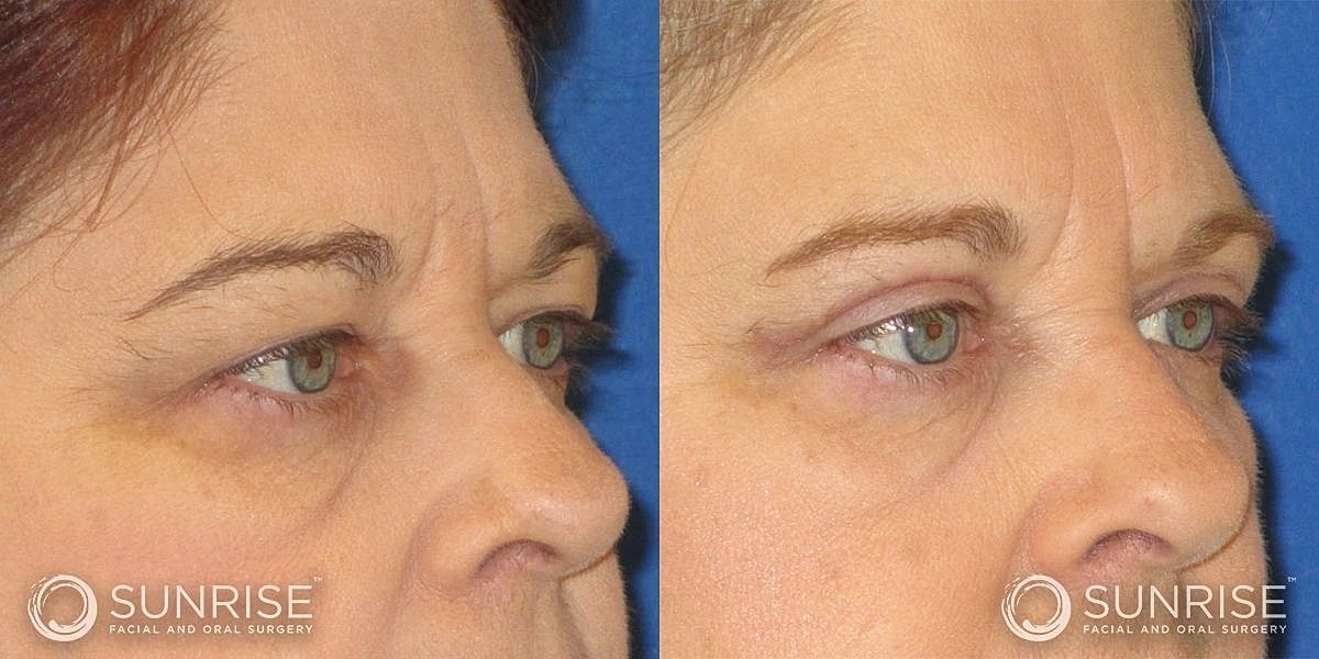 Blepharoplasty Before & After