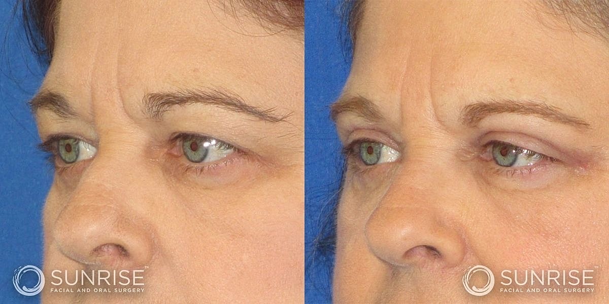 Blepharoplasty Before & After