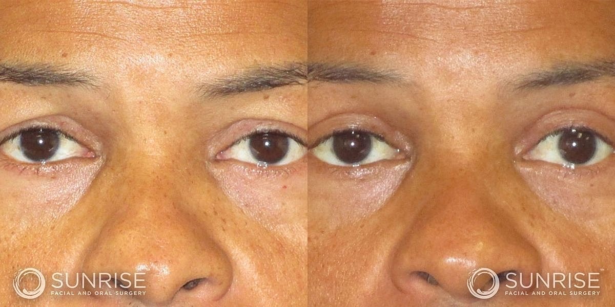 Blepharoplasty Before & After