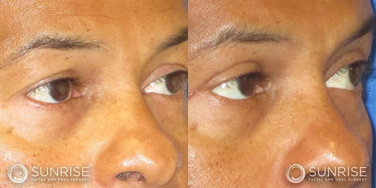 Blepharoplasty Before & After