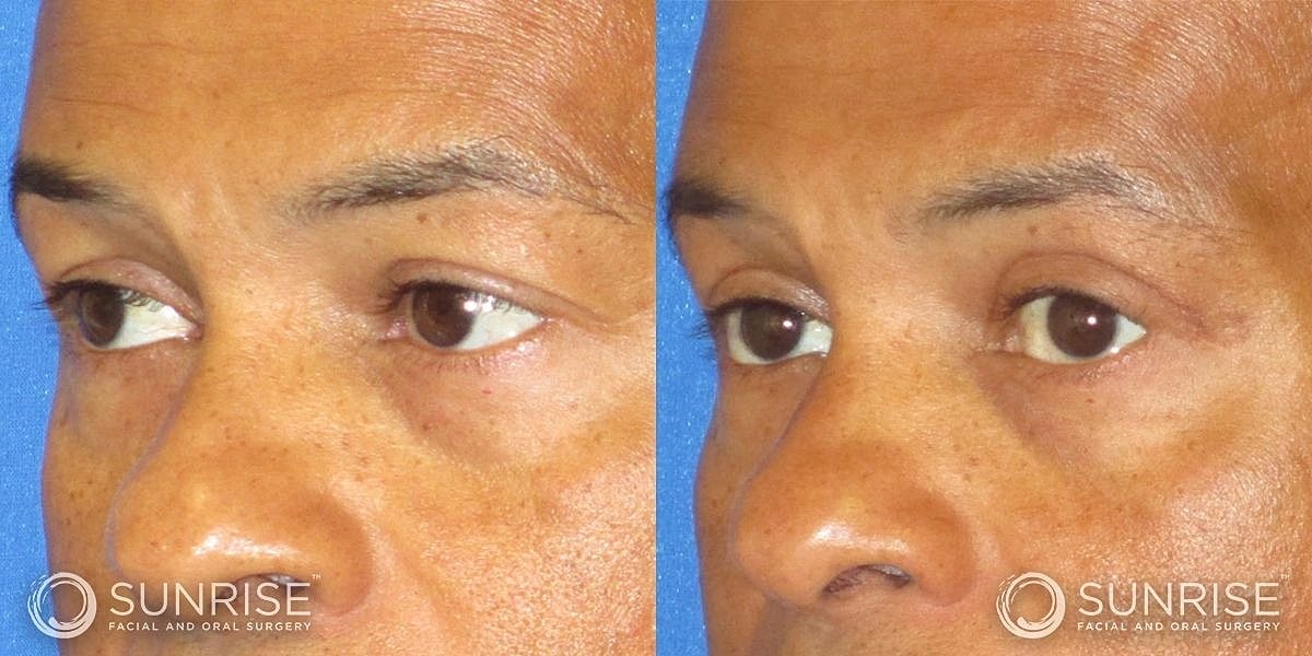 Blepharoplasty Before & After