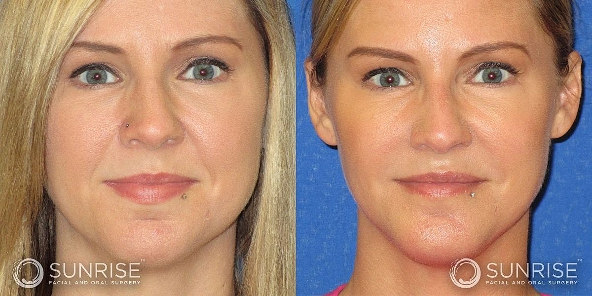 Facial Implants Before & After