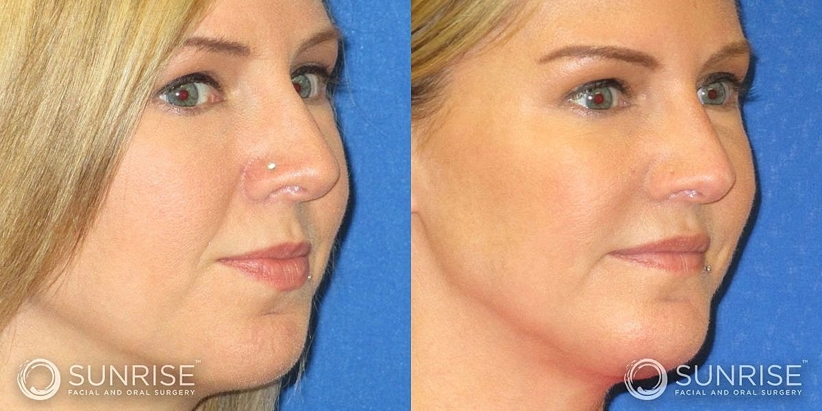 Facial Implants Before & After