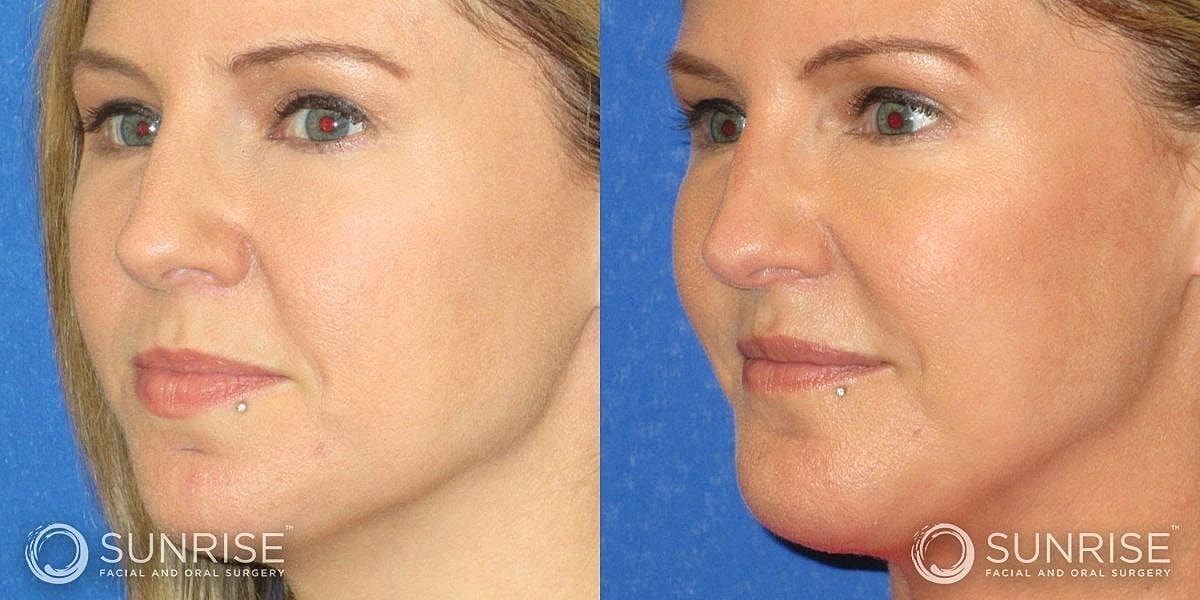 Facial Implants Before & After