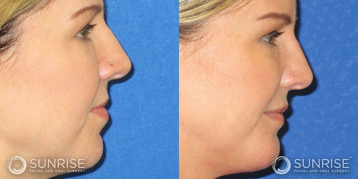 Facial Implants Before & After