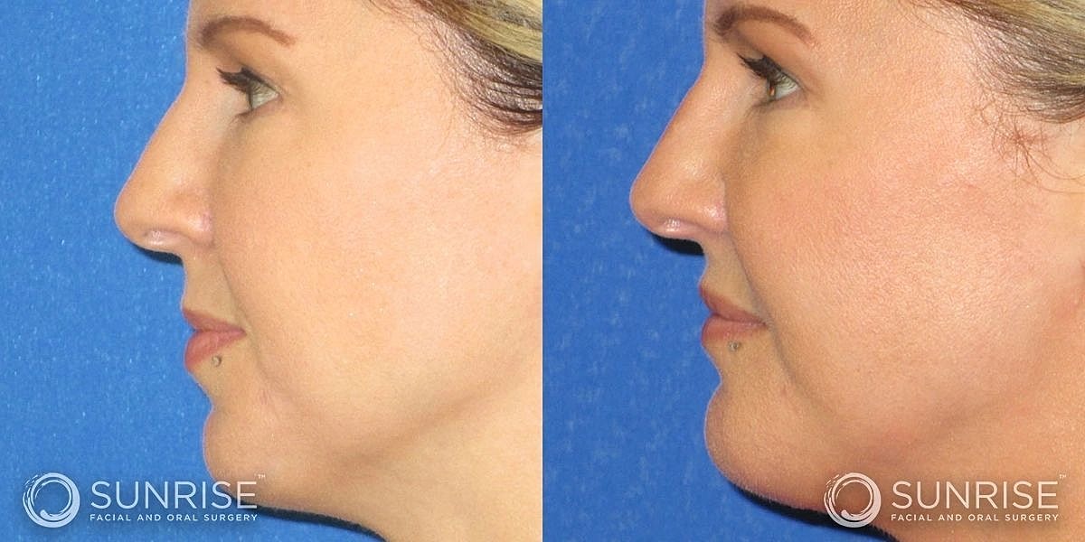 Facial Implants Before & After