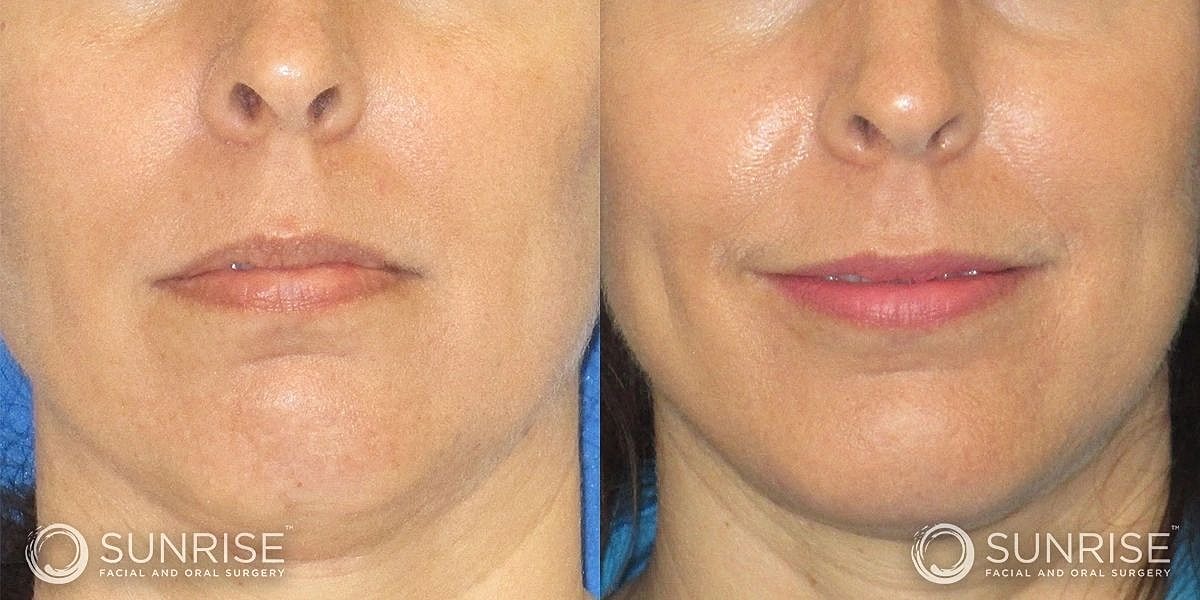Facial Implants Before & After