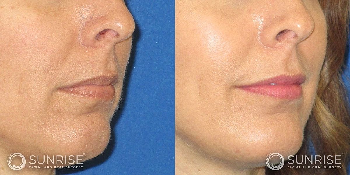 Facial Implants Before & After
