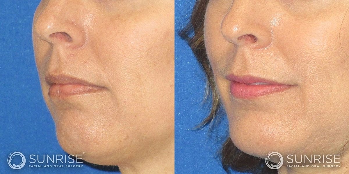 Facial Implants Before & After