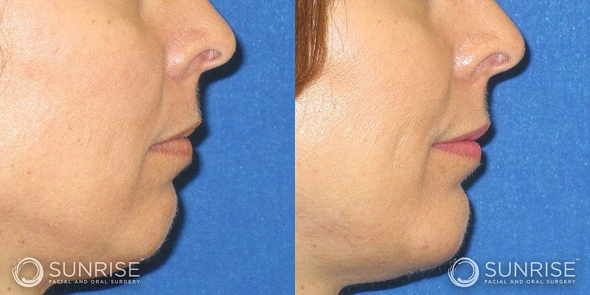 Facial Implants Before & After