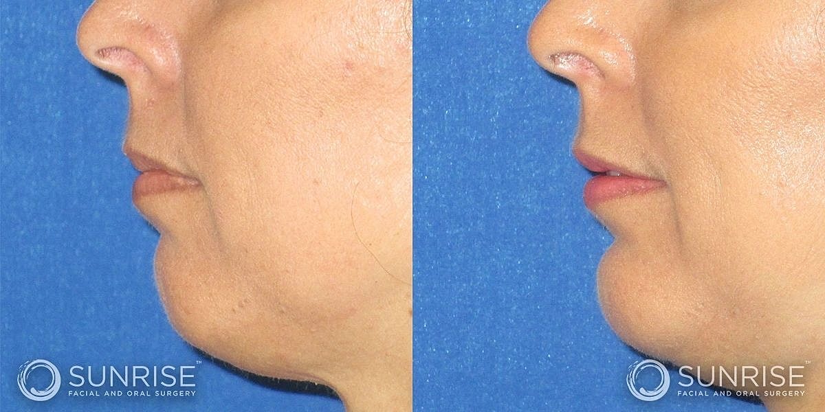 Facial Implants Before & After