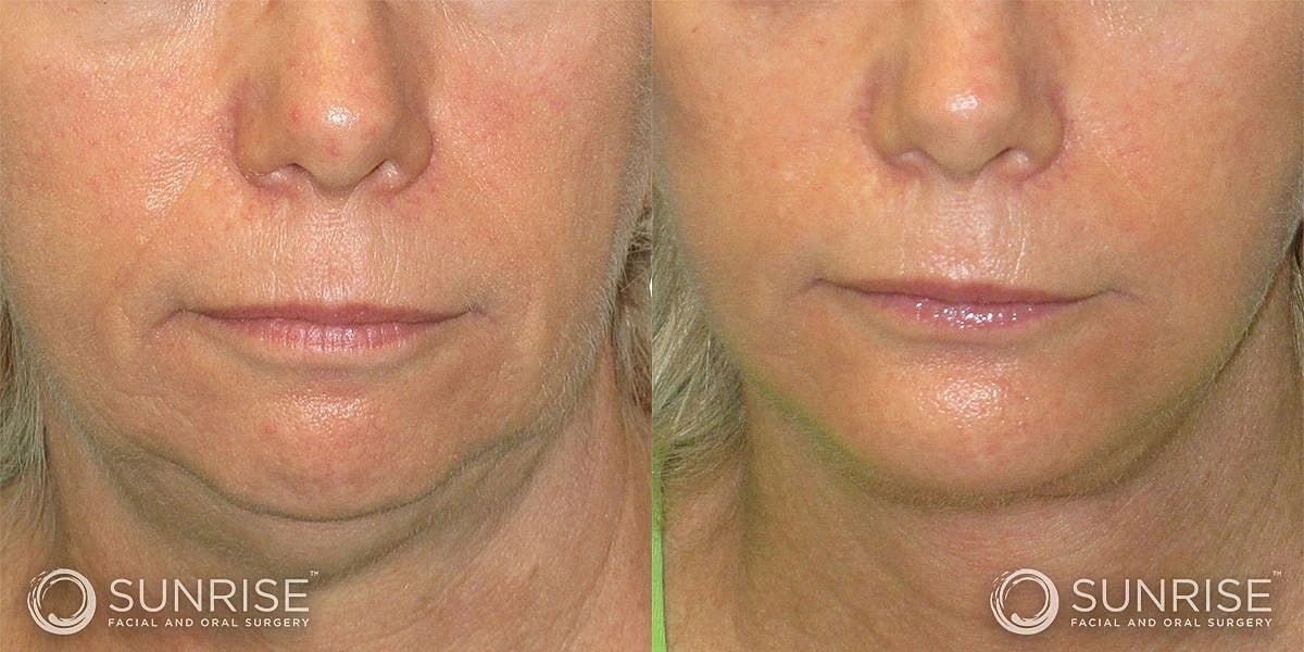 Facial Implants Before & After