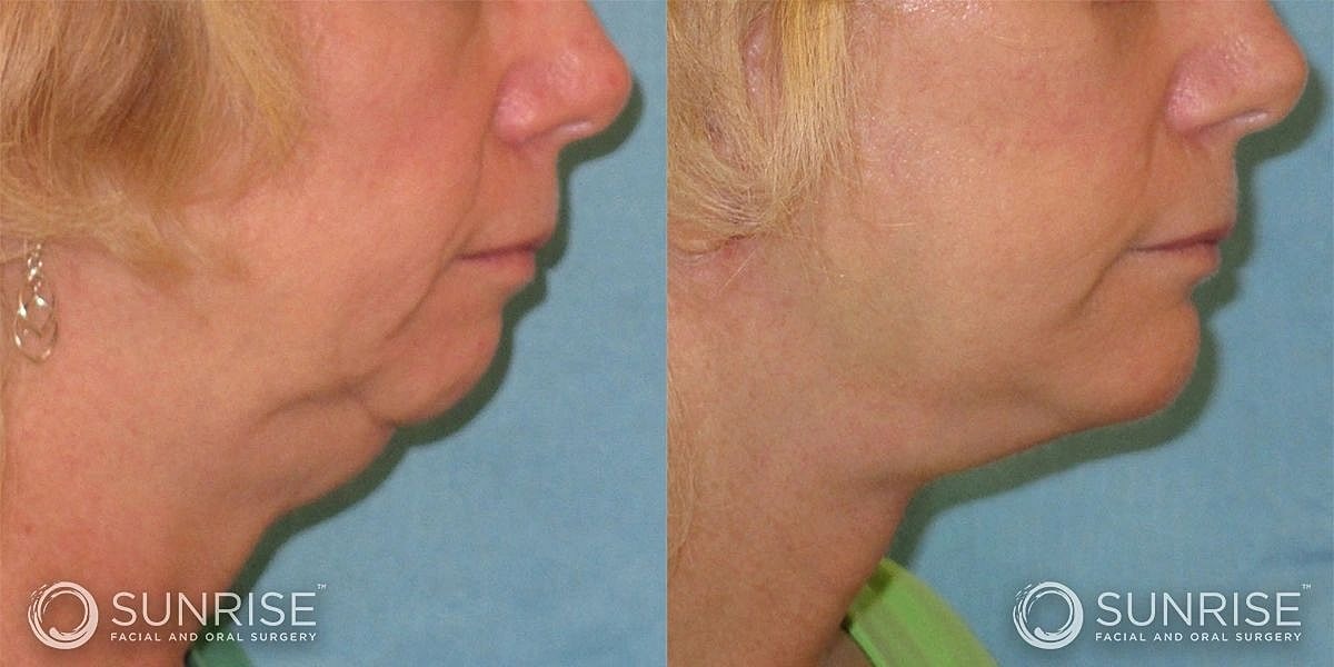 Facial Implants Before & After