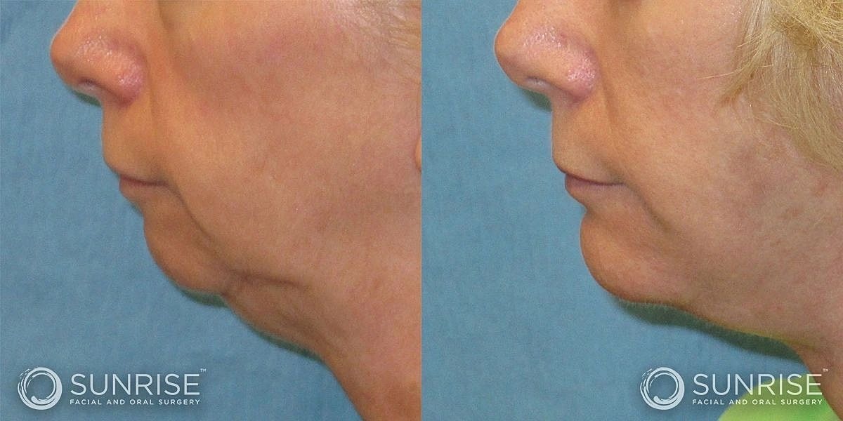 Facial Implants Before & After
