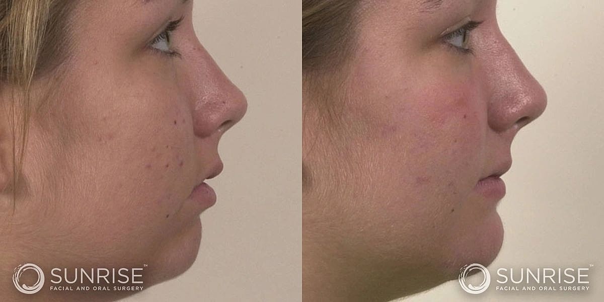 Facial Implants Before & After