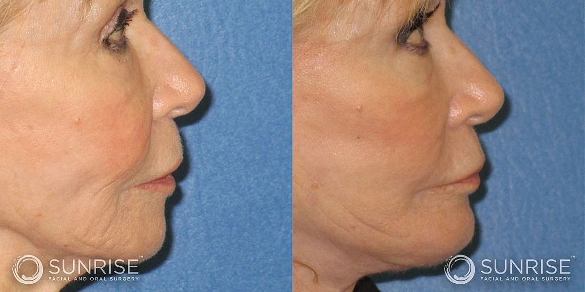 Facial Implants Before & After