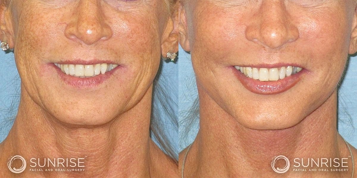 Facial Implants Before & After