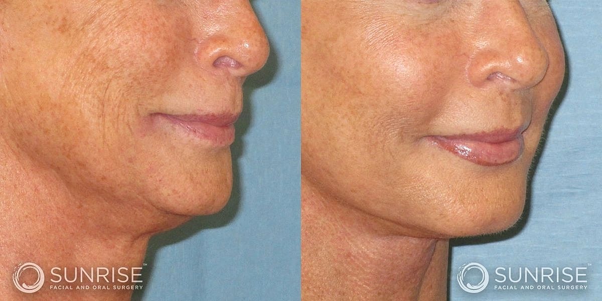 Facial Implants Before & After