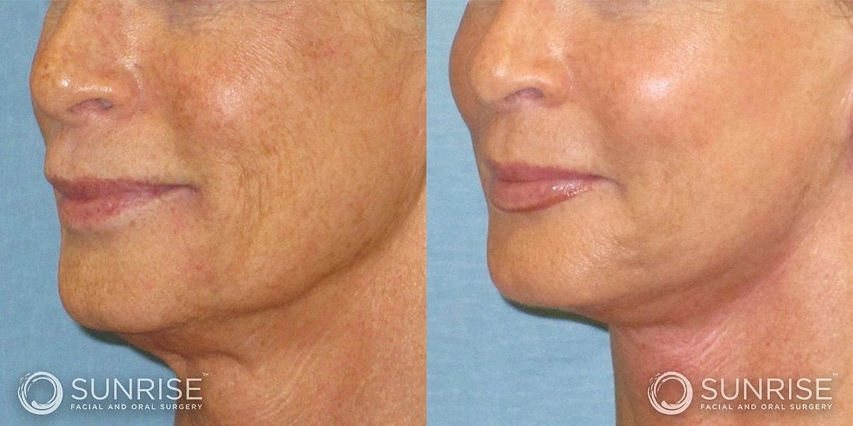 Facial Implants Before & After