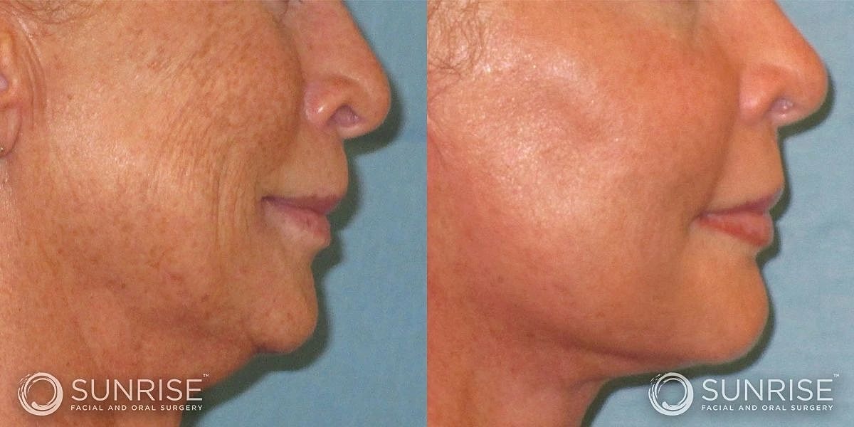 Facial Implants Before & After