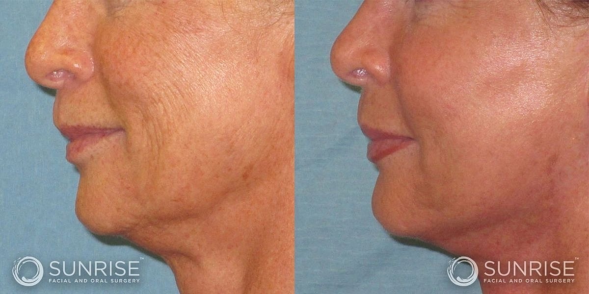 Facial Implants Before & After
