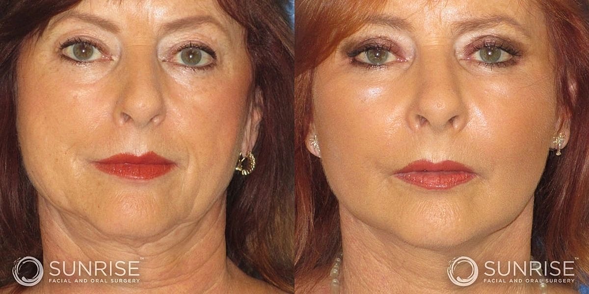 Facial Implants Before & After