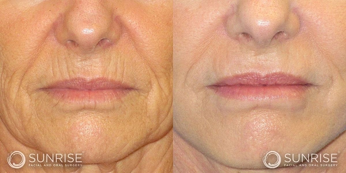 Dermal Fillers Before & After