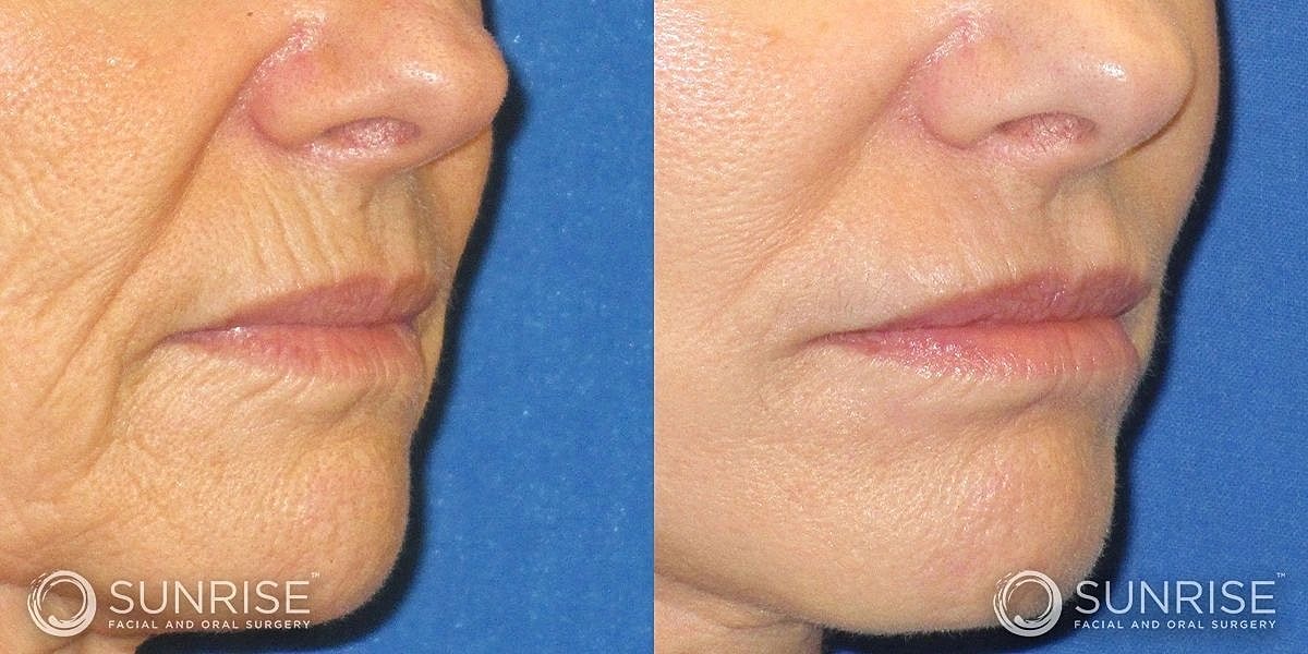 Dermal Fillers Before & After