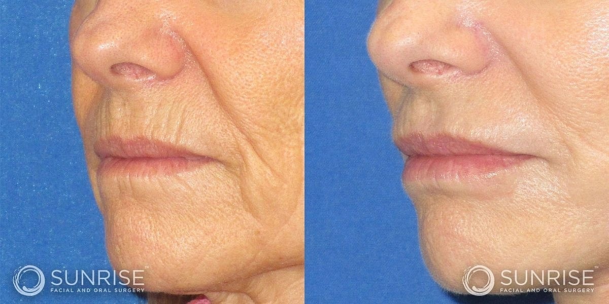 Dermal Fillers Before & After