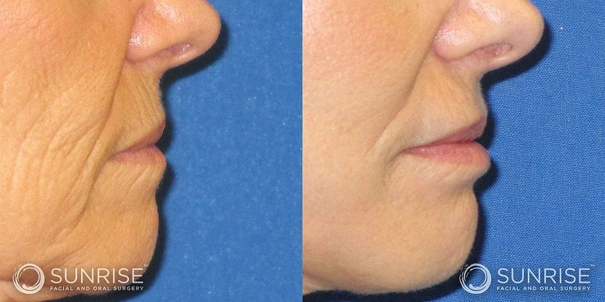 Dermal Fillers Before & After