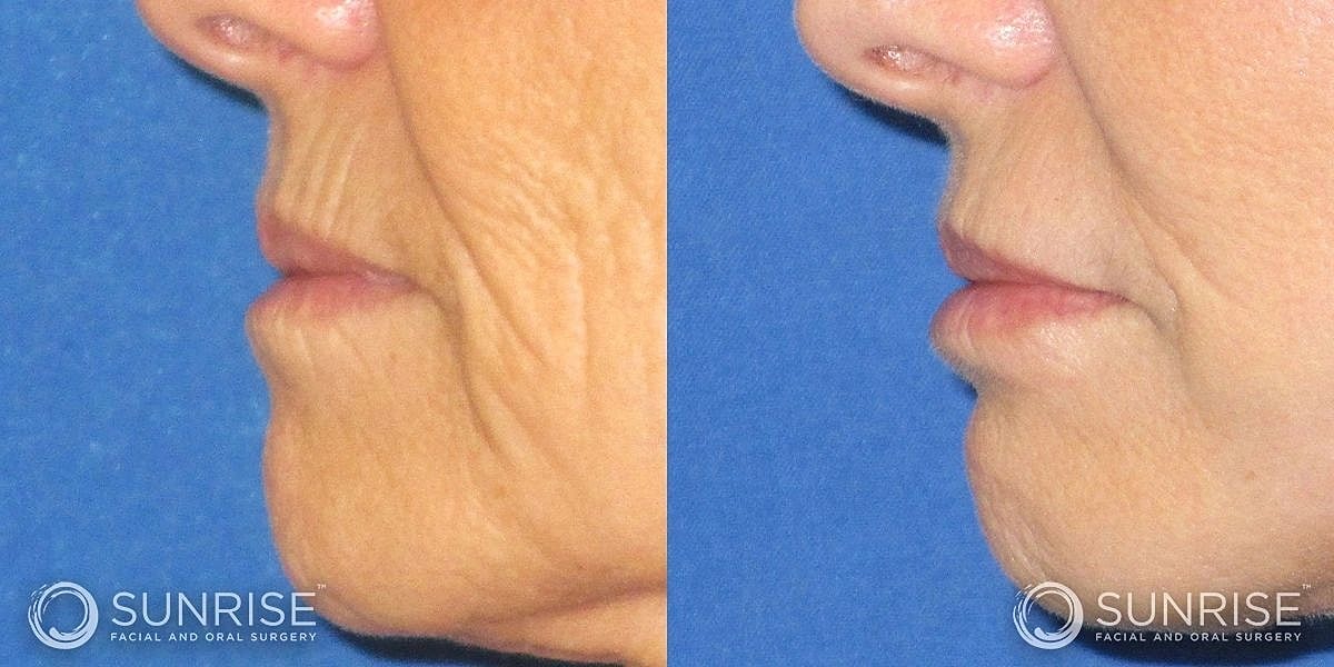 Dermal Fillers Before & After