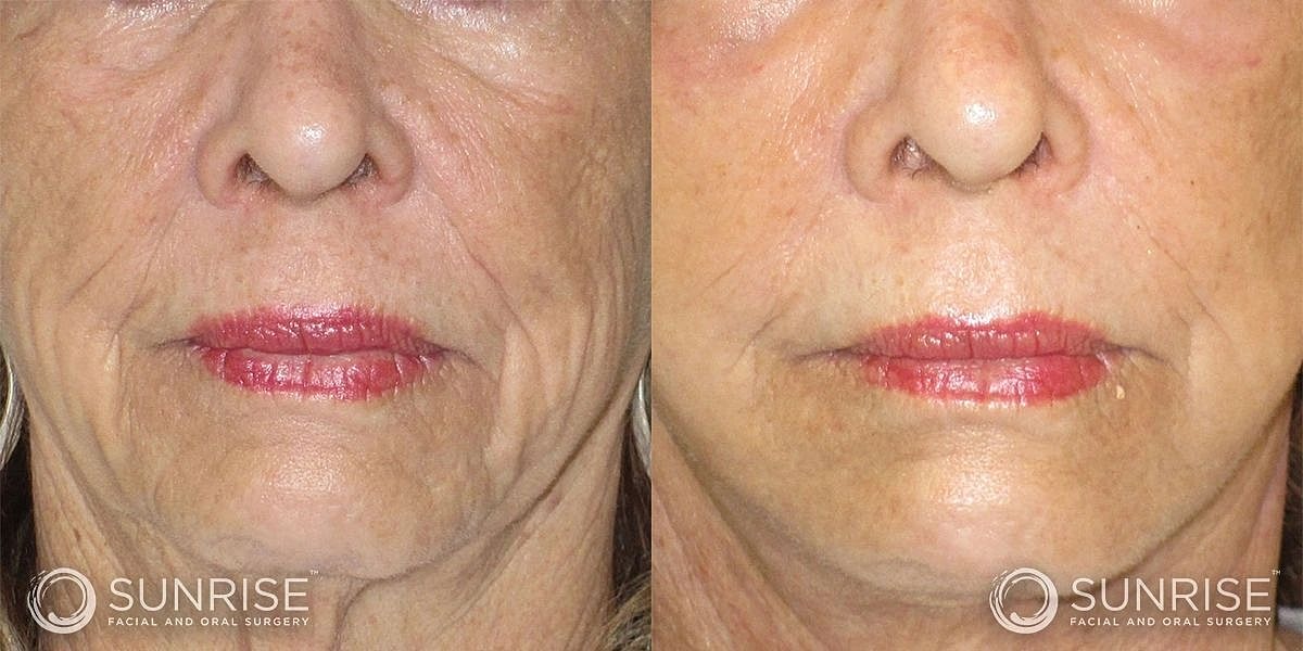 Dermal Fillers Before & After