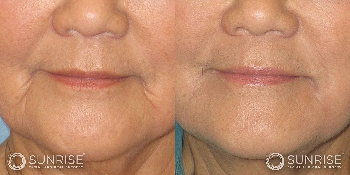 Dermal Fillers Before & After