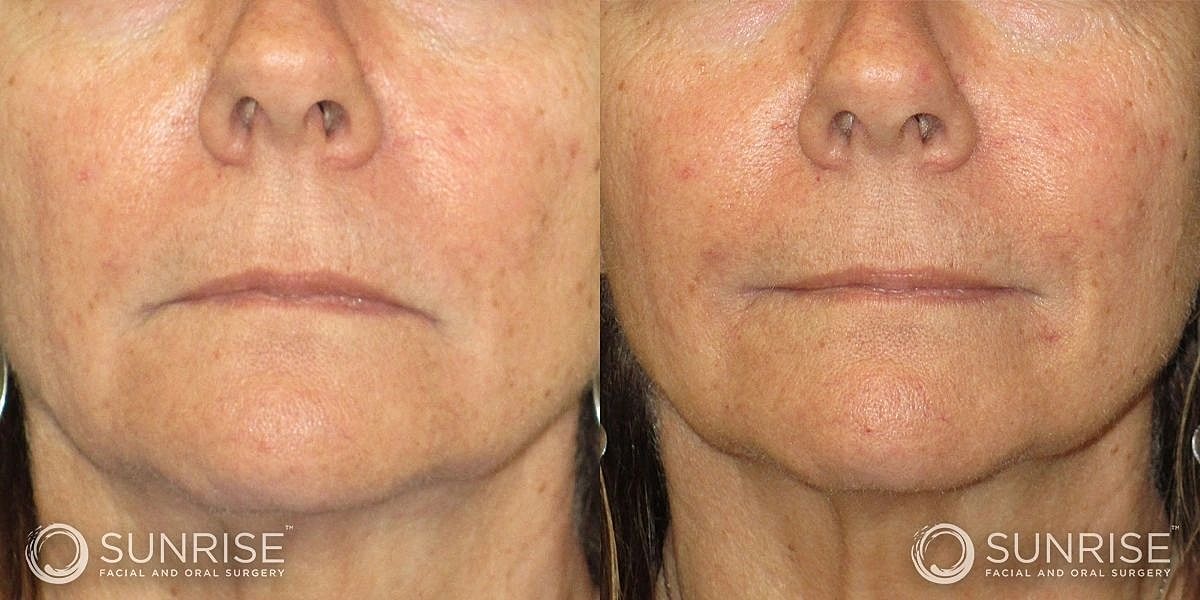 Dermal Fillers Before & After