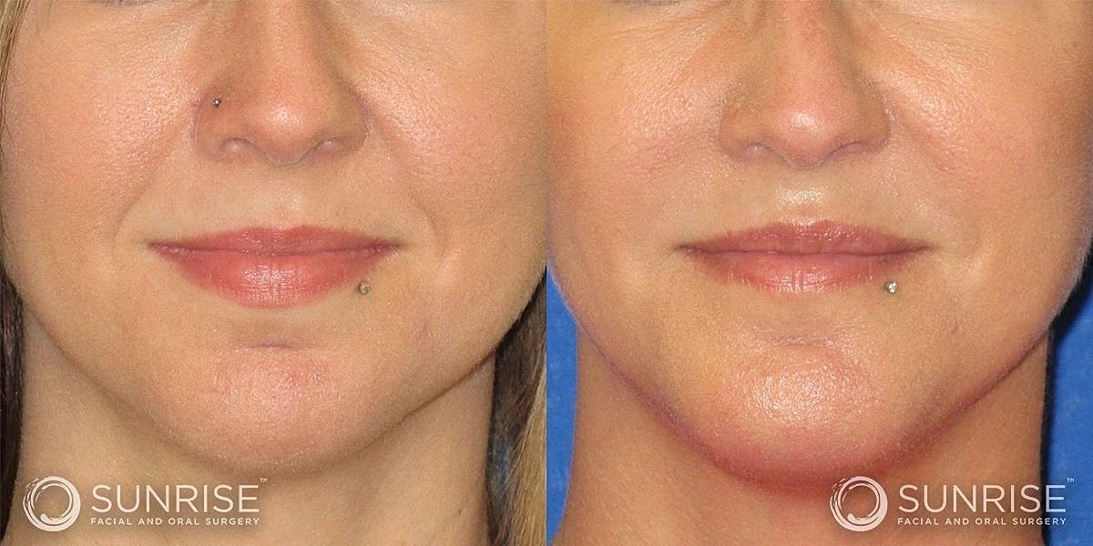 Dermal Fillers Before & After